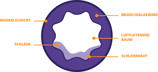 Abbildung einer gesunden Bronchie im Querschnitt im Vergleich zur Bronchie bei Asthma und zur Bronche beim Asthma-Anfall